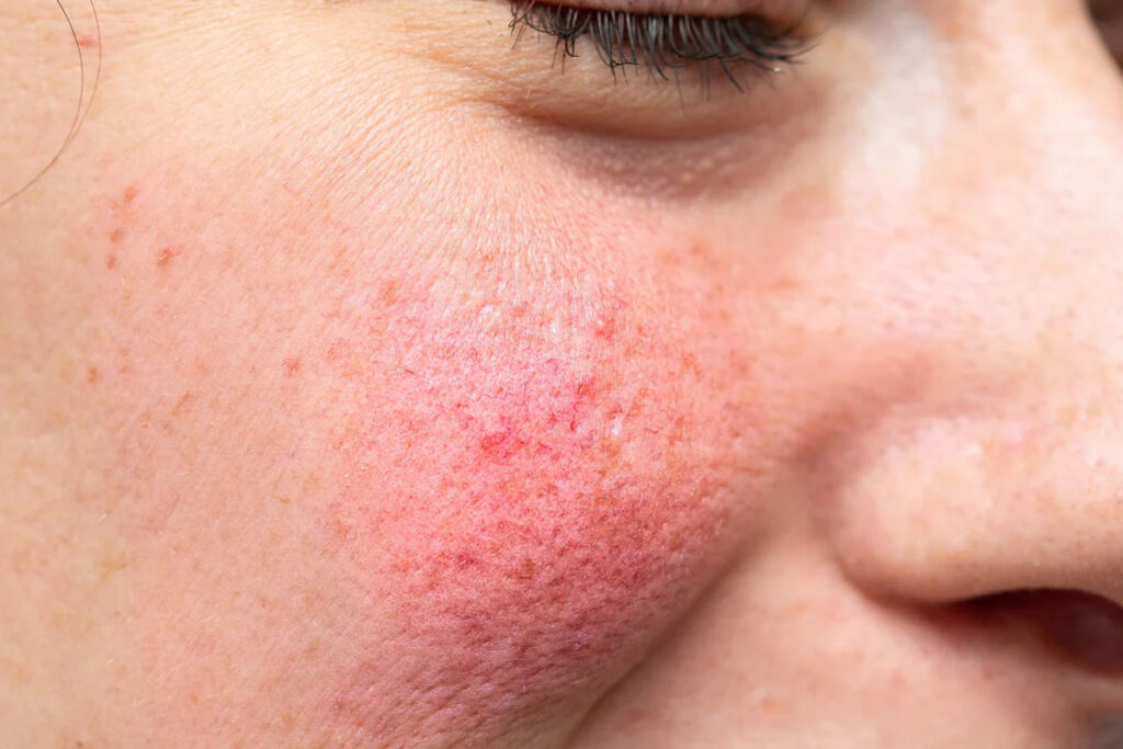 rosacea