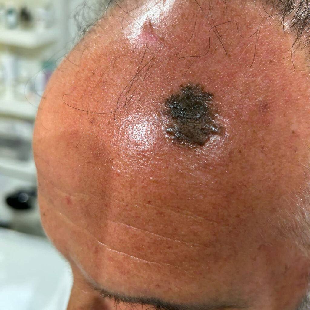 cheratosi seborroica prima