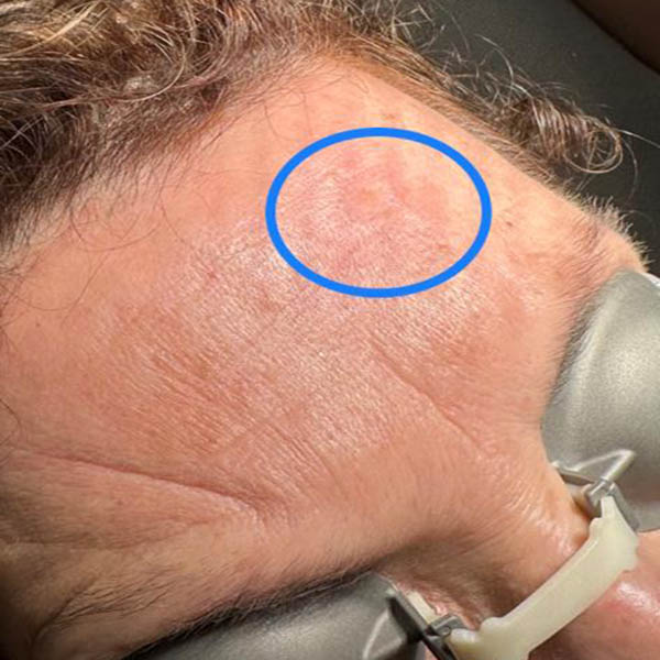 laser co2 rimozione cheratosi seborroica in regione frontale post intervento