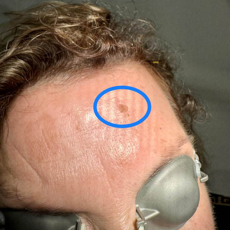 laser co2 rimozione cheratosi seborroica in regione frontale prima dell' intervento