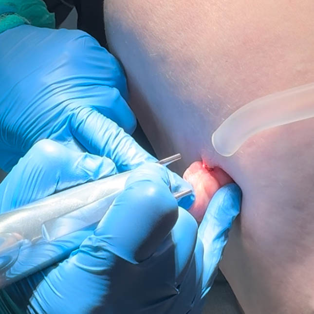 Grosso fibroma pendulo prima