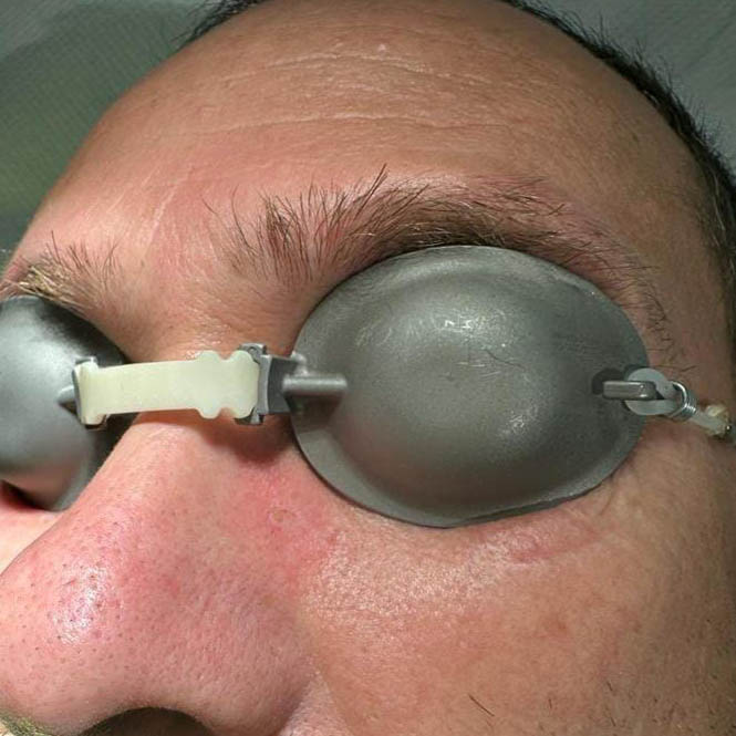 post rimozione verruca filiforme con laser Co2