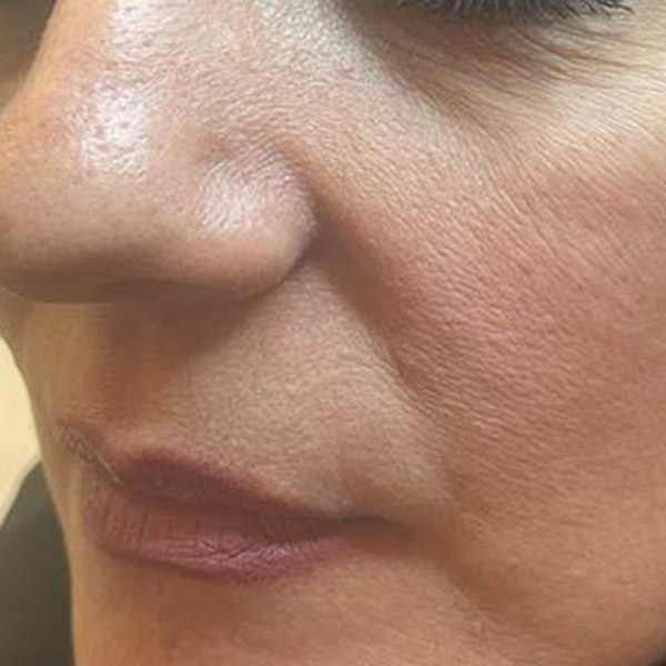 Dermochirurgia con laser CO2 effettuata rimozione laser ed esame istologico di una neoformazione benigna del volto dopo