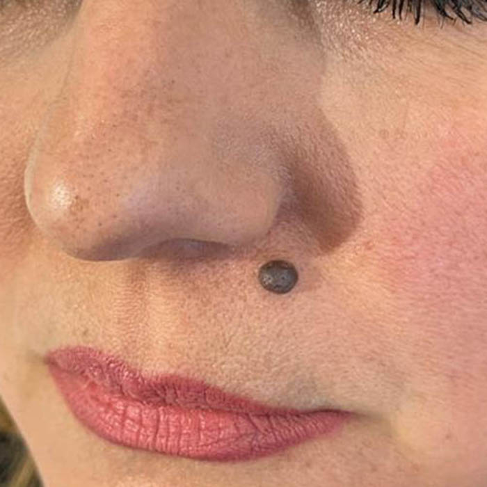 Neoformazione benigna del volto prima