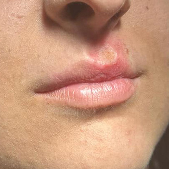 dopo - Nevo Dermico al labbro superiore, eseguito Shaving con Laser C02