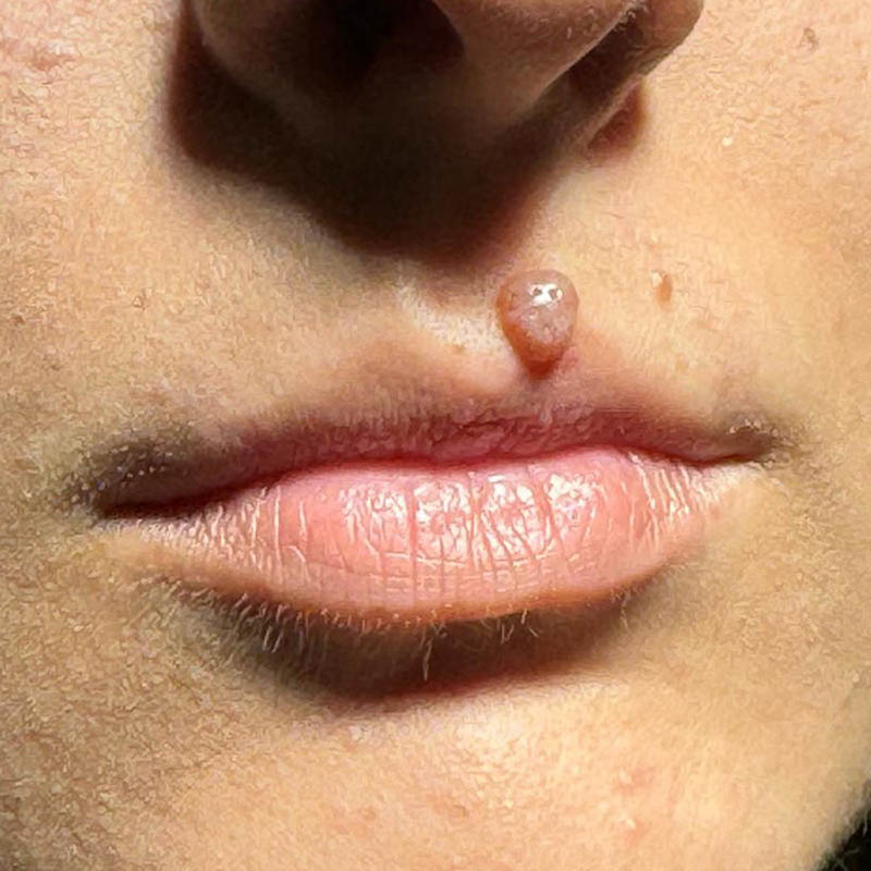 Nevo dermico al labbro superiore, prima