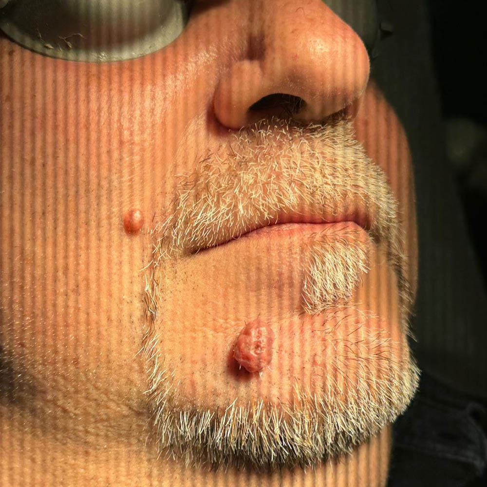 Prima Neoformazione Dermica del volto