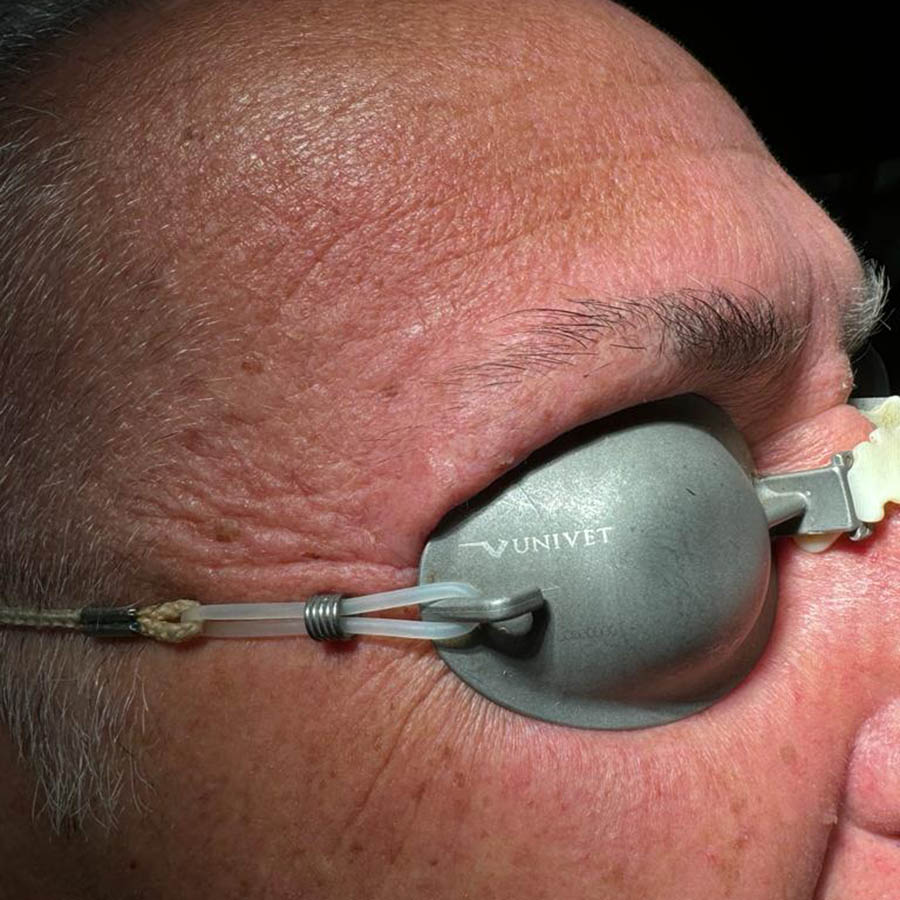 Rimozione Cheratosi Seborroica regione palpebrale superiore destra tramite Laser Co2 dopo intervento