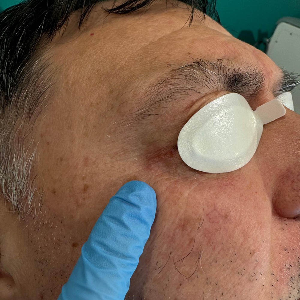 Post Rimozione Idrocistoma occhio sx con laser CO2