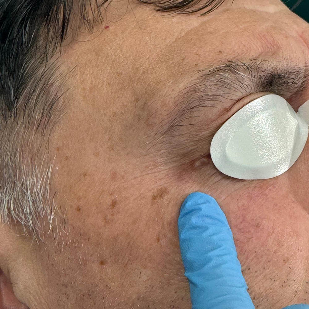 Idrocistoma occhio sx prima