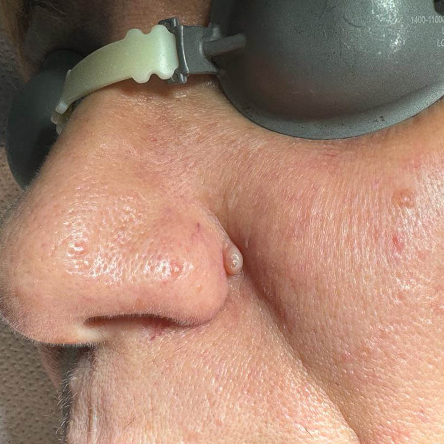 Neoformazione Dermica naso prima