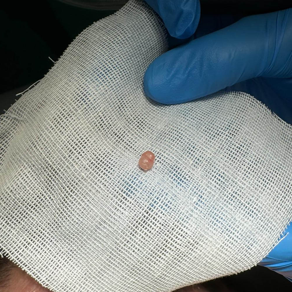 Rimozione Tricoepitelioma palpebra superiore con Laser CO2 dopo