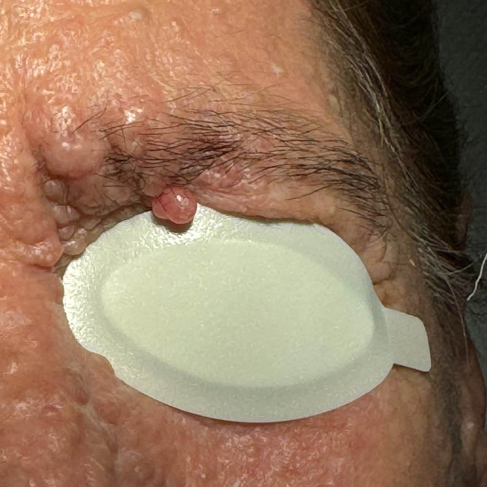 Tricoepitelioma palpebra superiore prima