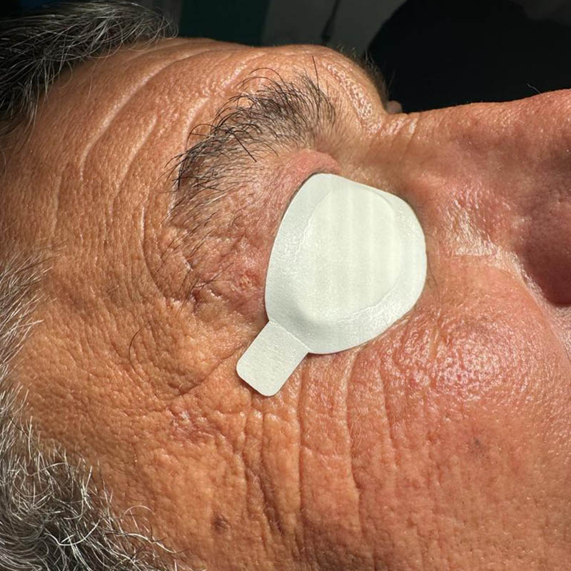 Rimozione di Neoformazioni fibromatose mediante Laser Co2 dopo