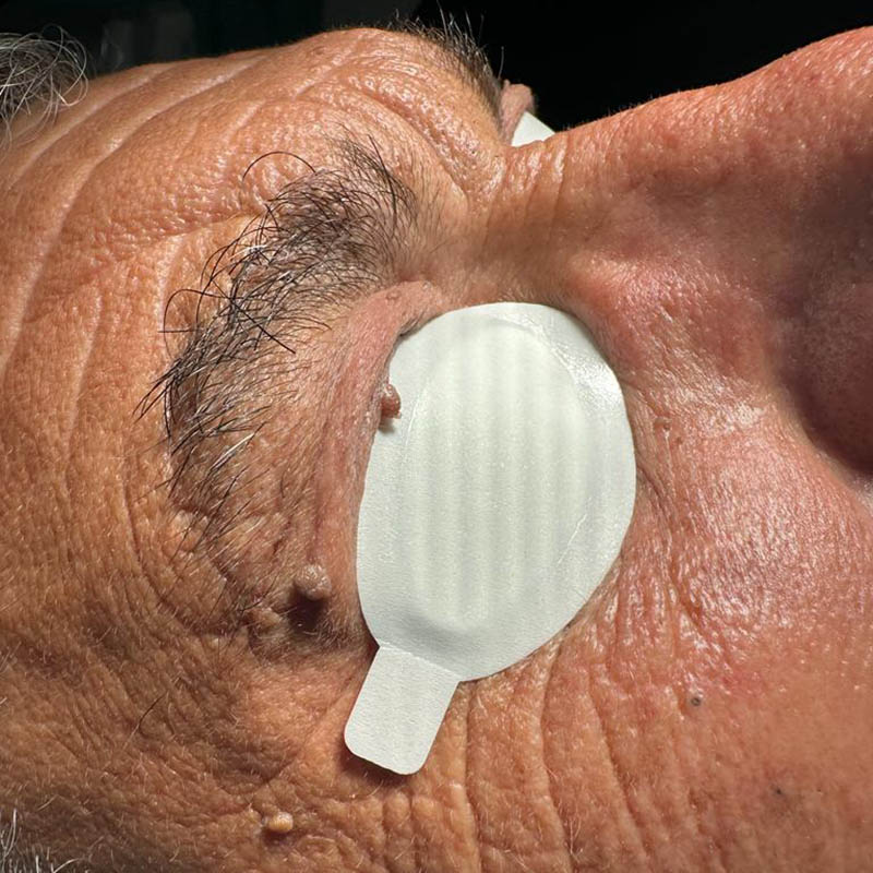 Neoformazioni fibromatose prima