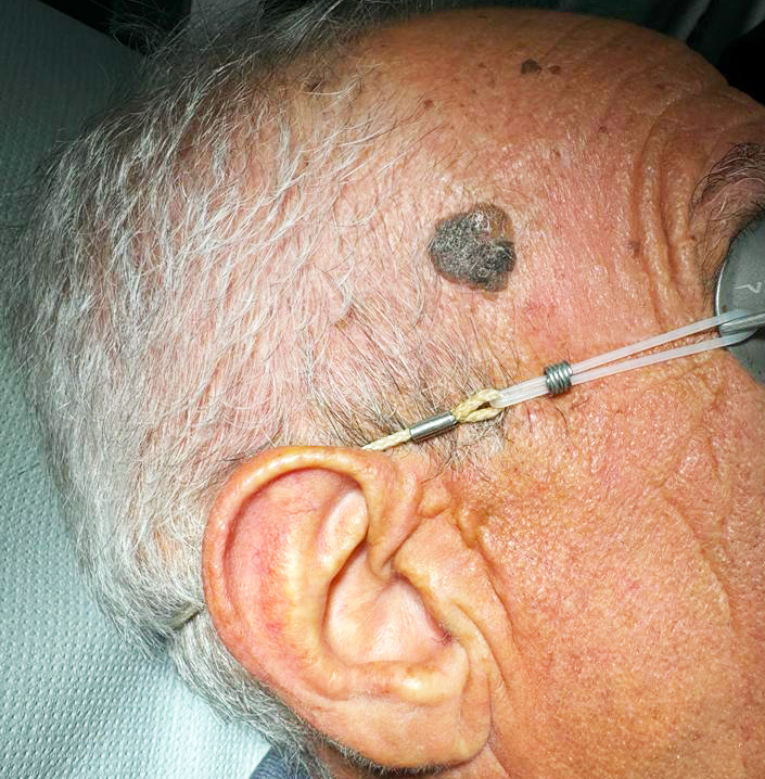 Grossa cheratosi seborroica del volto prima