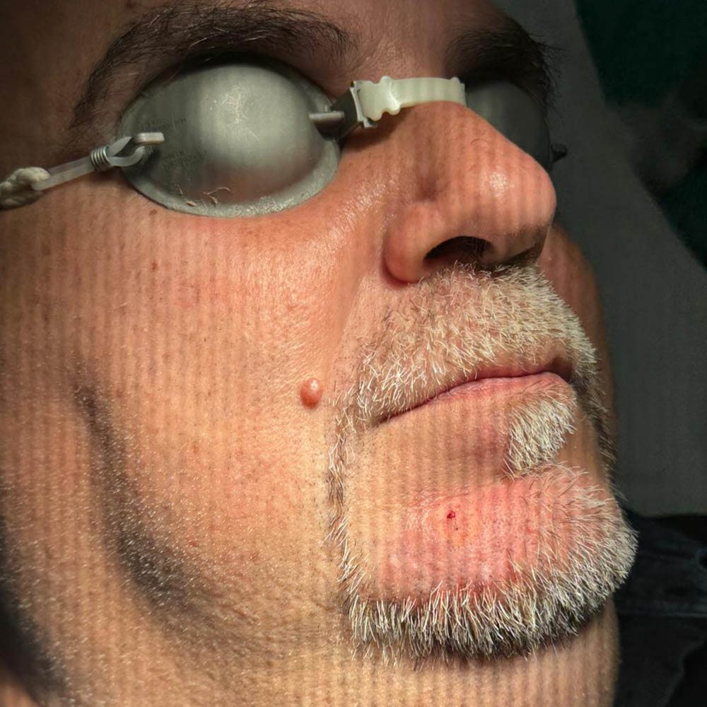 dopo rimozione Neoformazione Dermica del volto con Laser CO2