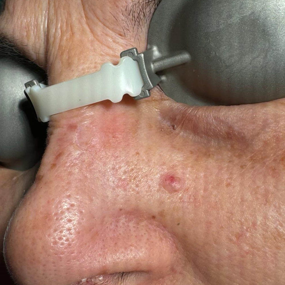 dopo rimozione cheratosi seborroica regione nasale con laser co2