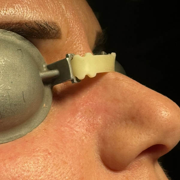 post intervento Rimozione Lesione Verrucosa del volto con Laser Co2