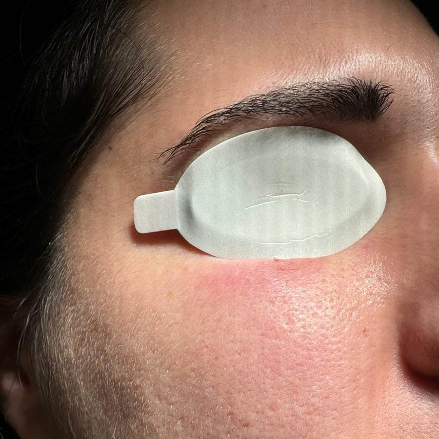 post rimozione lesione verrucosa con laser co2