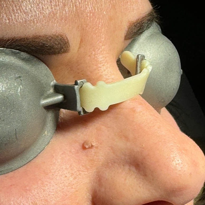 prima Lesione Verrucosa del volto