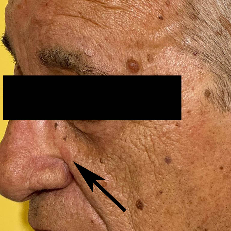 nevo dermico di grosse dimensioni rimozione con laser co2 dopo