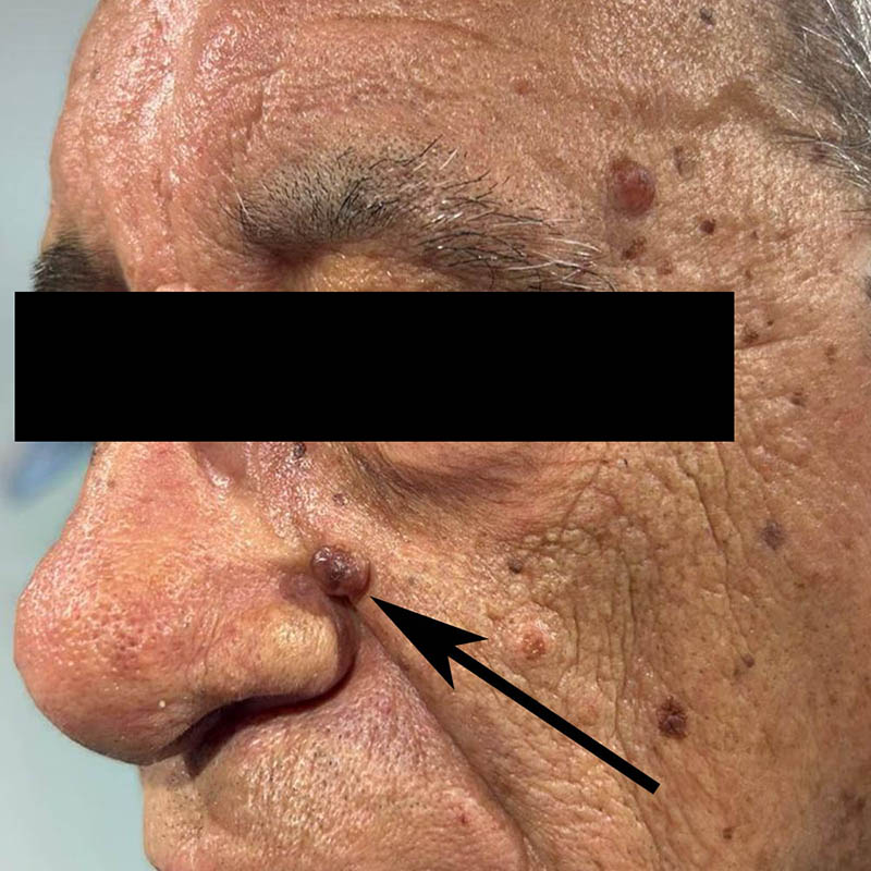 nevo-dermico-di-grosse-dimensioni rimozione con laser co2 prima